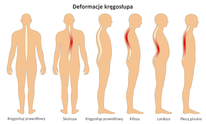 Skrzywienia kręgosłupa. Źródło: shutterstock