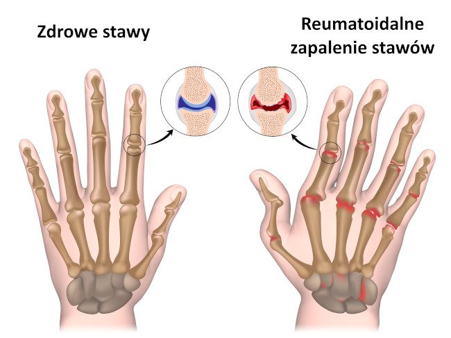 Reumatoidalne zapalenie stawów. Źródło: shutterstock