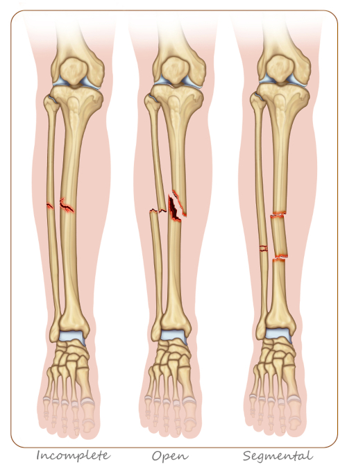 Rodzaje złamań kości piszczelowej. Źródło: shutterstock