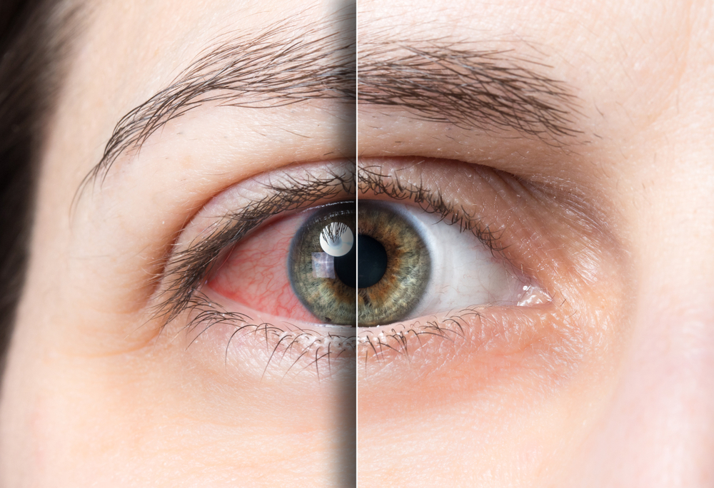 Ból oczu może mieć różne przyczyny i objawy. Źródło: shutterstock