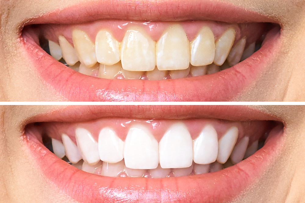 Zęby przed i po wybielaniu. Źródło: shutterstock