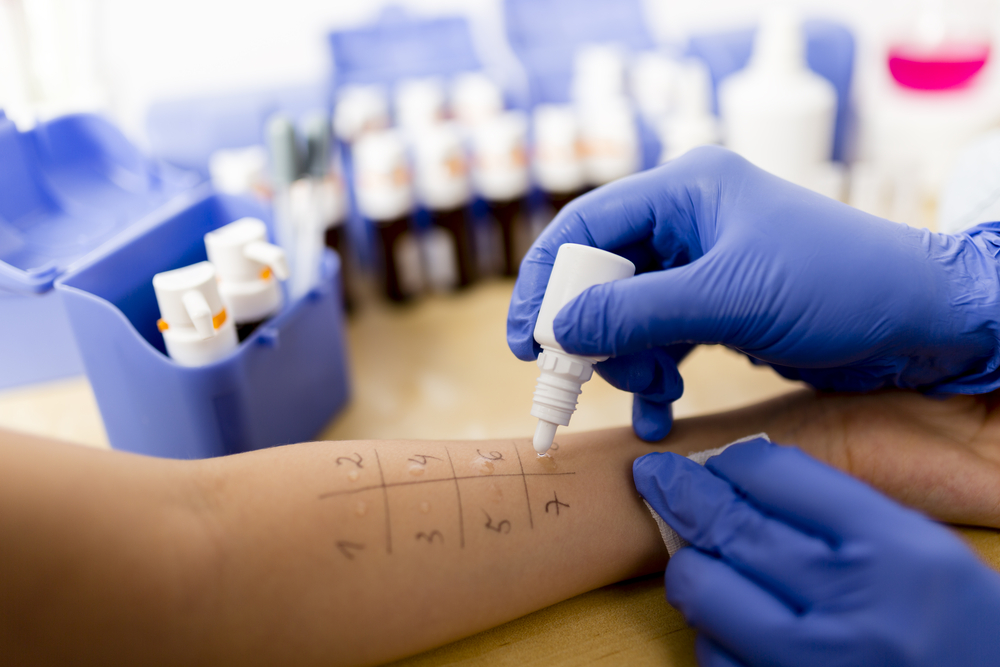 Test skórny na alergie u dziecka. Źródło: shutterstock