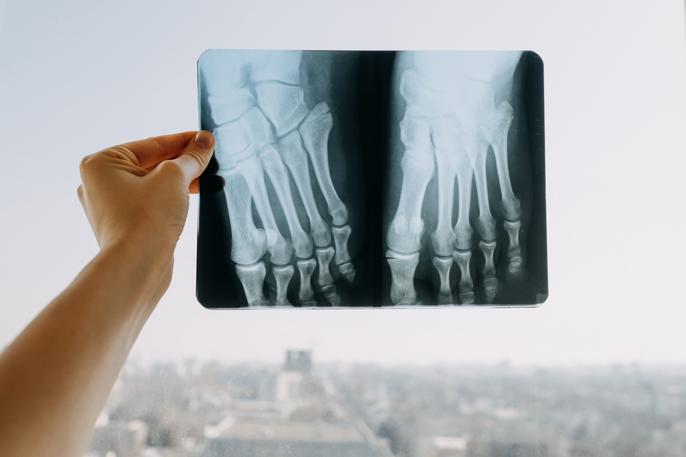 Zdjęcie rentgenowskie stopy. Źródło: shutterstock