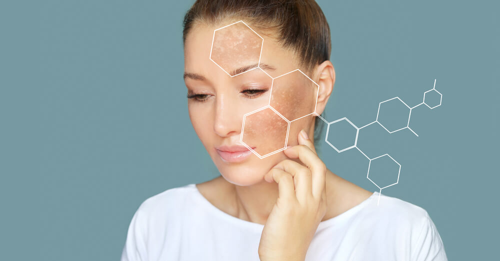 Kwas traneksamowy rozjaśnia przebarwienia hiperpigmentacyjne